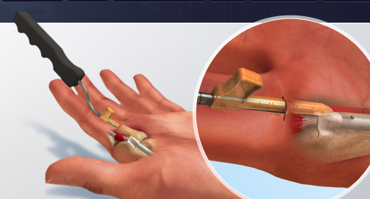 Trigger Tome® Minimally Invasive Trigger Finger Release (Prod 2007162)